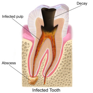 toothdecay